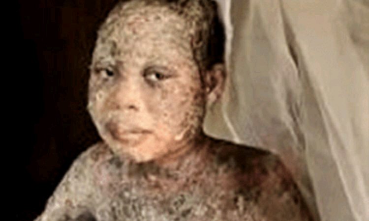 My father poured acid on me because I refused to deny Jesus – Former Muslim Lady Narrates