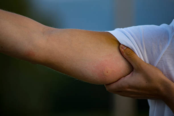 6 Ways On How to Get Rid of Mosquito Bites Overnight