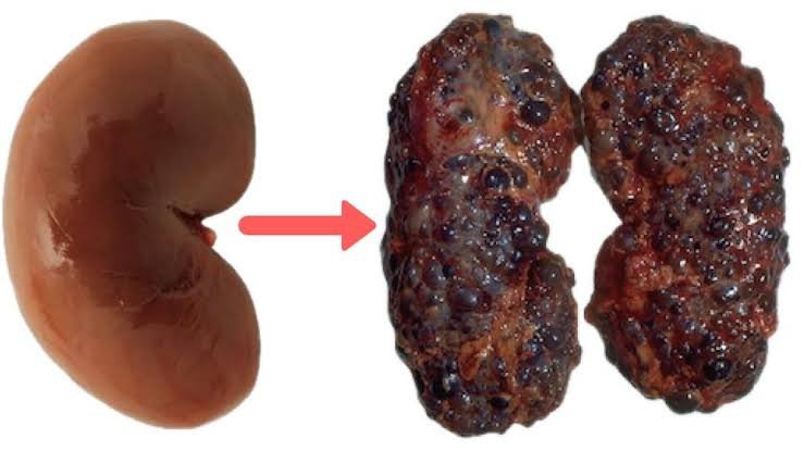 5 Types Of Foods That Slowly Damages Your Kidneys When Taken In Excess